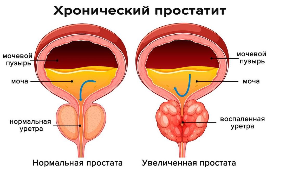 Простатит: симптомы, на которые стоит обратить внимание